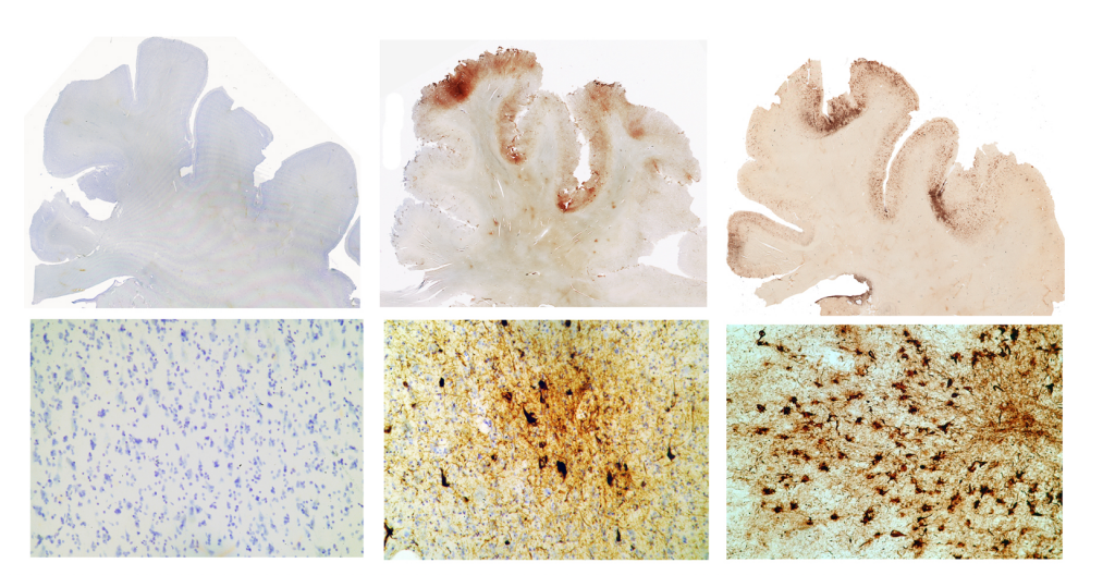 What a CTE patient's brain looks like under the microscope.